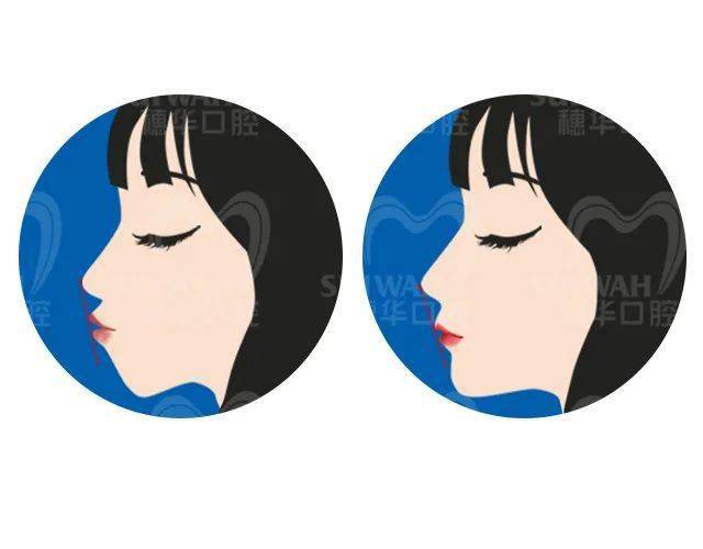 龅牙|广州95后女生从小龅牙，嘴巴都快闭不上！朋友却劝她不要矫牙，一年后......