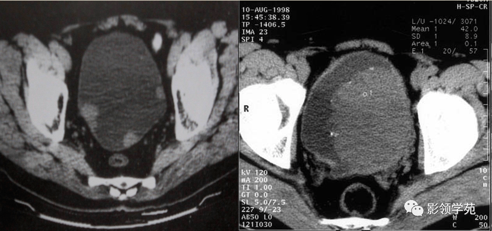 膀胱癌影像表现