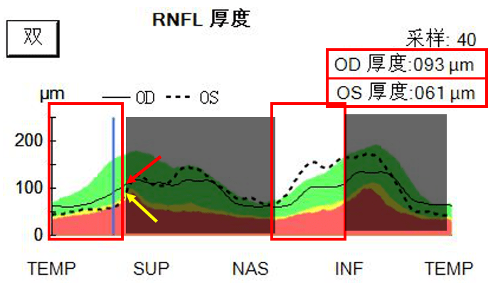 左眼(虚线)落在黄色及红色范围内,表明左眼rnfl厚度降