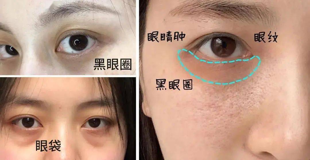 黑眼圈|blingbling大眼秘诀！早晚滚两下，赶走黑眼圈、细干纹！