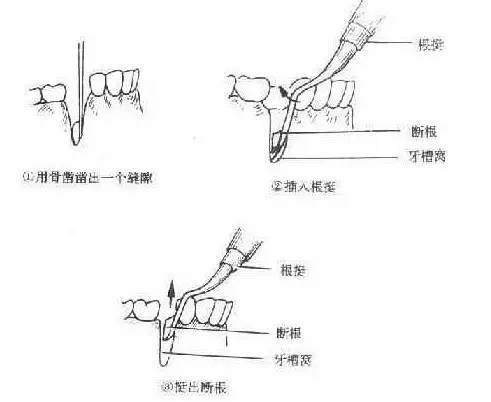 牙挺的类别基本使用方法及注意事项