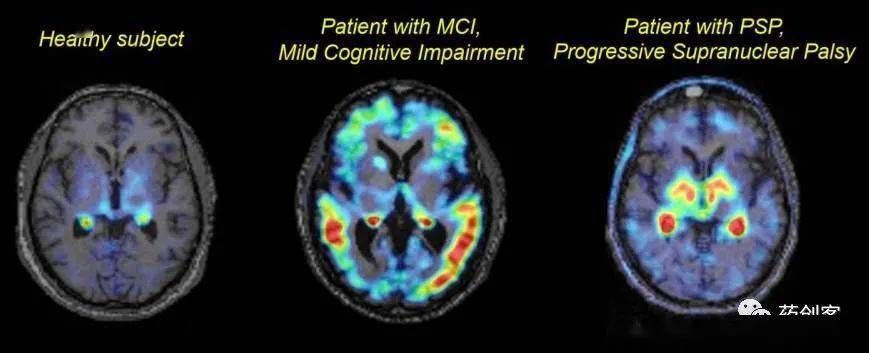 精确诊断阿尔茨海默症,国内首个tau蛋白pet示踪剂临床试验获受理