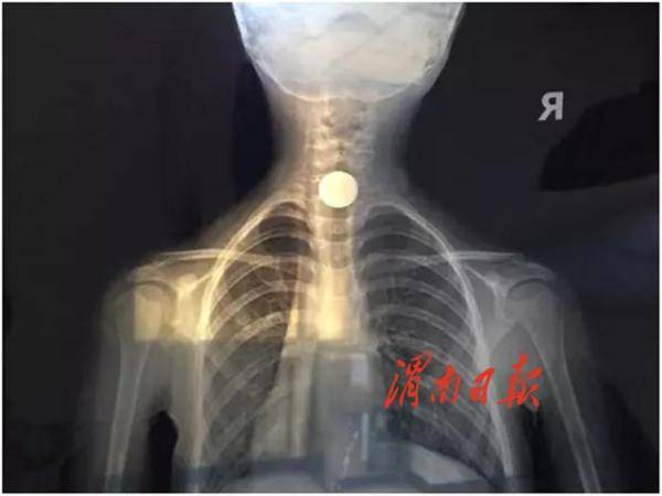 孩子|警惕“祸从口入”！儿童吞食异物 家长切莫大意