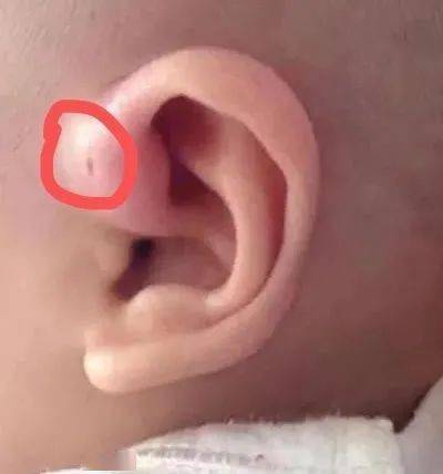 耳朵上的小洞(耳仓)是福气的象征?