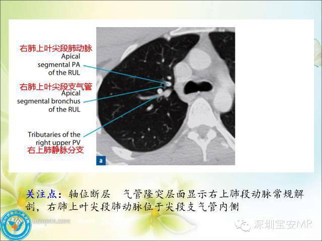 解剖心脏大血管丨肺动脉和肺静脉影像断层解剖