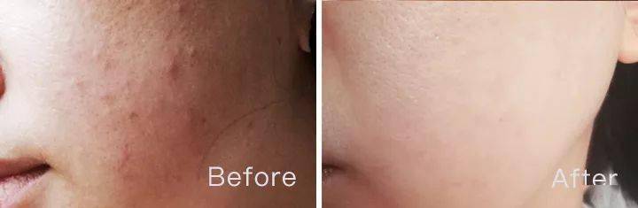 脸蛋|你的脸蛋“一键美颜”,除了滤镜还靠什么?