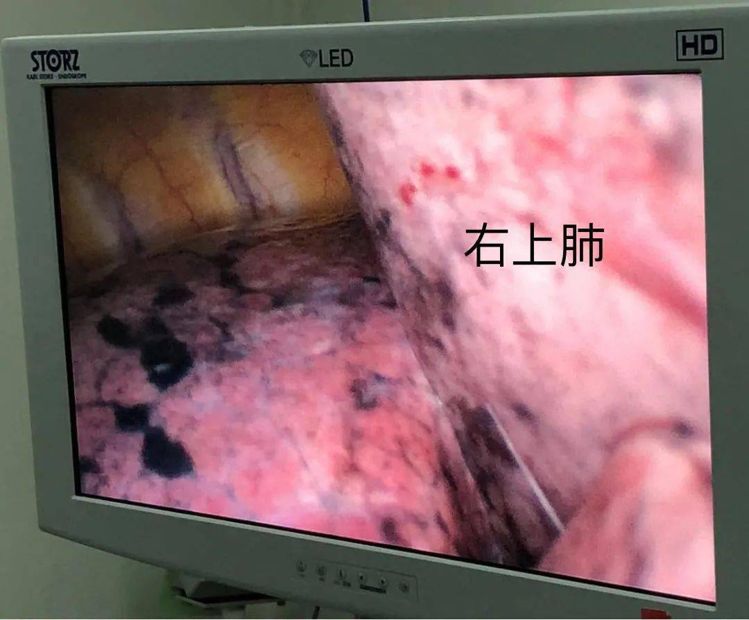 技术分享支气管堵塞器在多发肺肿瘤切除术中的灵活运用