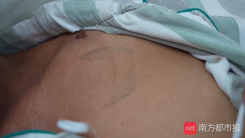 雷电|雷击突出物，打伞、高空作业都很“突出“两男子因雷击进急诊