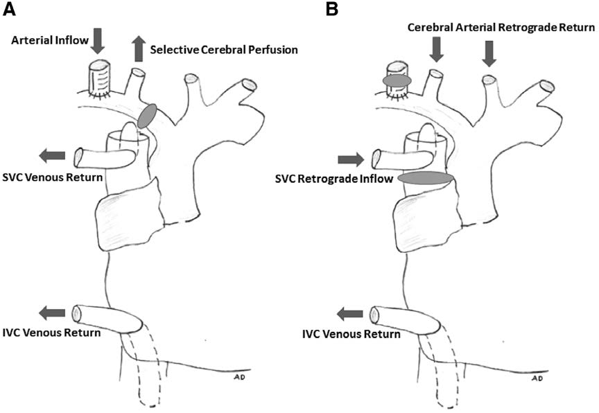筛查|高危患者术前该进行胸部CT检查和颈动脉筛查!美国心脏协会发布心脏手术预防中风声明
