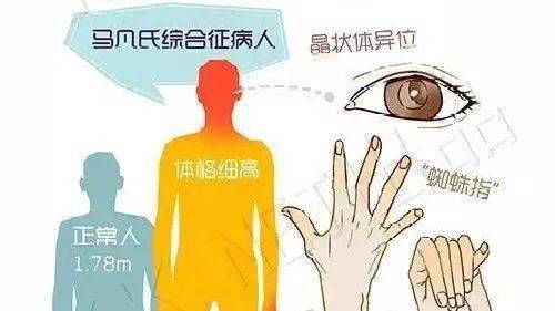 患者|一家三人都是高个子、大长腿，竟然是这种可怕的遗传病！