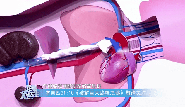 症状|16cm！年轻患者长出巨大癌栓，背后原因竟是“它”！出现这些症状需警惕
