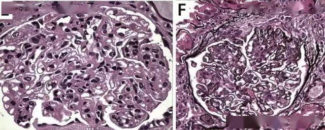 综合征|不一样的肺出血肾炎综合征