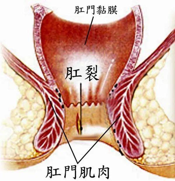 只要用手轻轻分开病人的肛门,就能在肛管后正中线处发现有典型裂口