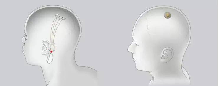 马斯克|马斯克将芯片接入猪脑！说可以存储、下载记忆，网友：可怕…