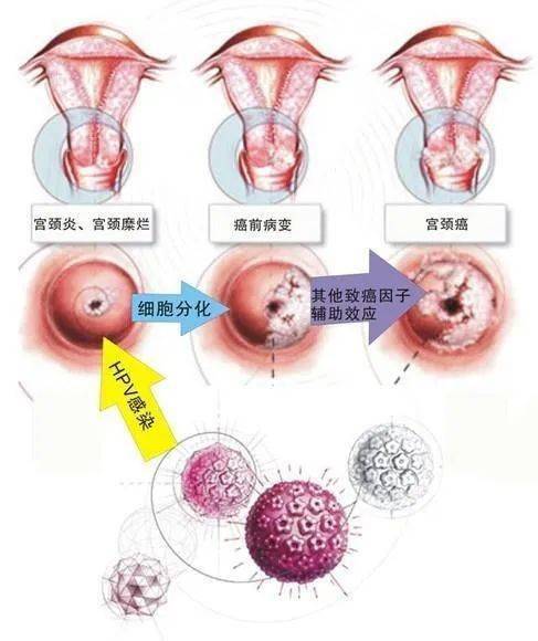 胆结石腰疼怎么办