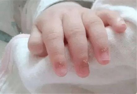 白点|孩子指甲上的月牙、白点、竖纹、分层、咬指甲......是有大病的征兆？