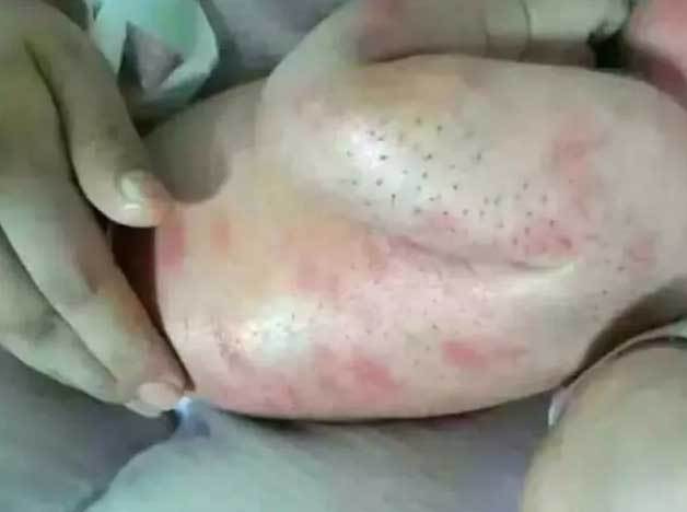 毒刺|得知原因后妈妈气坏了！宝宝身上长满黑色“毒刺”