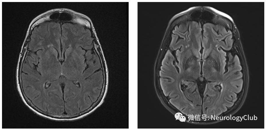 (图1:左:flair可见双侧纹状体高信号;右:3月后复查可见脑萎缩,外侧裂