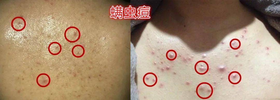 痘痘|背上长痘？神奇“液体”硫磺皂，60秒揪出万千螨虫，李佳琦卖了3万瓶！