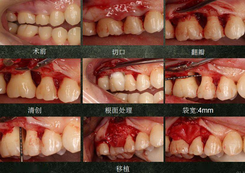 局限型侵袭性牙周炎及牙龈退缩治疗病例分享