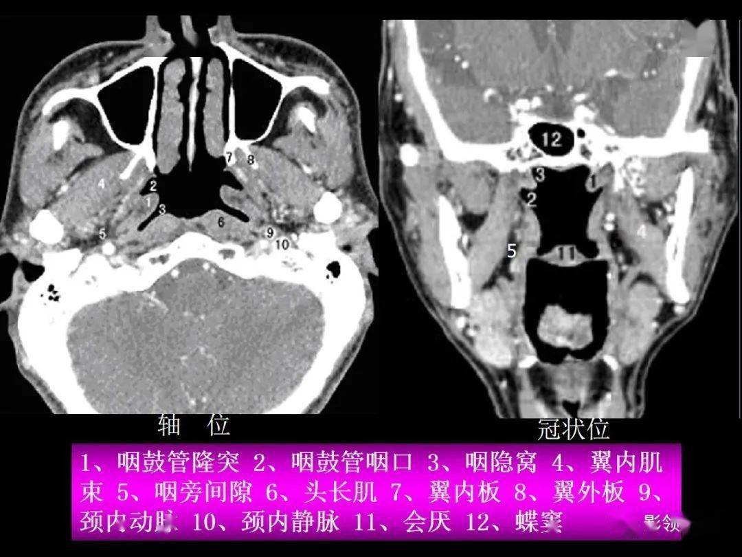 鼻咽部ct解剖