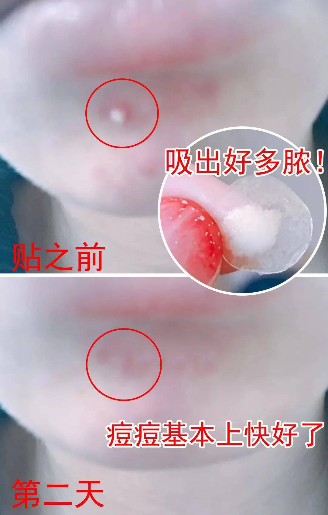 痘痘|“拔”出黄脓，快速消痘！让肌肤变成“白煮蛋”，就是这么简单！