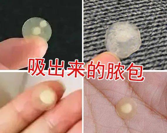 痘痘|“拔”出黄脓，快速消痘！让肌肤变成“白煮蛋”，就是这么简单！