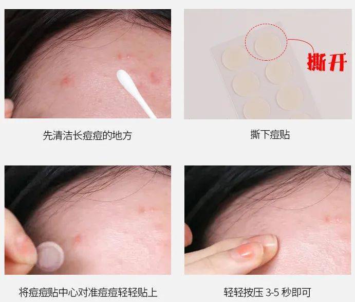 痘痘|“拔”出黄脓，快速消痘！让肌肤变成“白煮蛋”，就是这么简单！