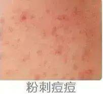 贫民窟|杨幂熬夜后护肤要花2万块？怪不得皮肤吹弹可破！贫民窟女孩就不配消除熬夜痘、黑眼圈吗？