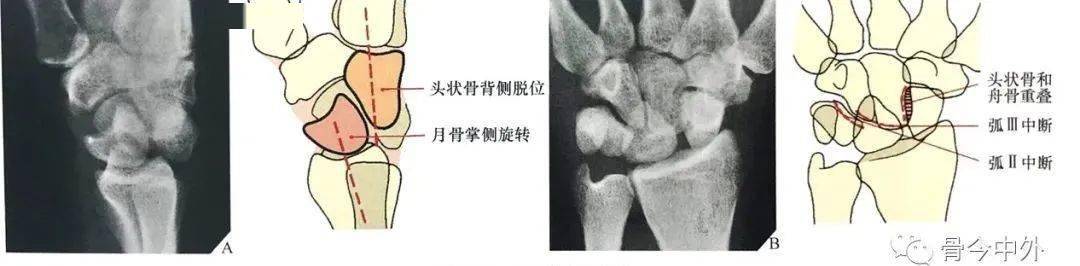 虽然月骨轻度掌侧旋转,但仍保留在与桡骨远端所形成的关节内