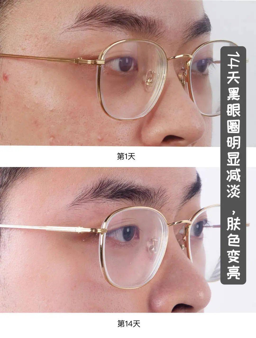 贫民窟|杨幂熬夜后护肤要花2万块？怪不得皮肤吹弹可破！贫民窟女孩就不配消除熬夜痘、黑眼圈吗？