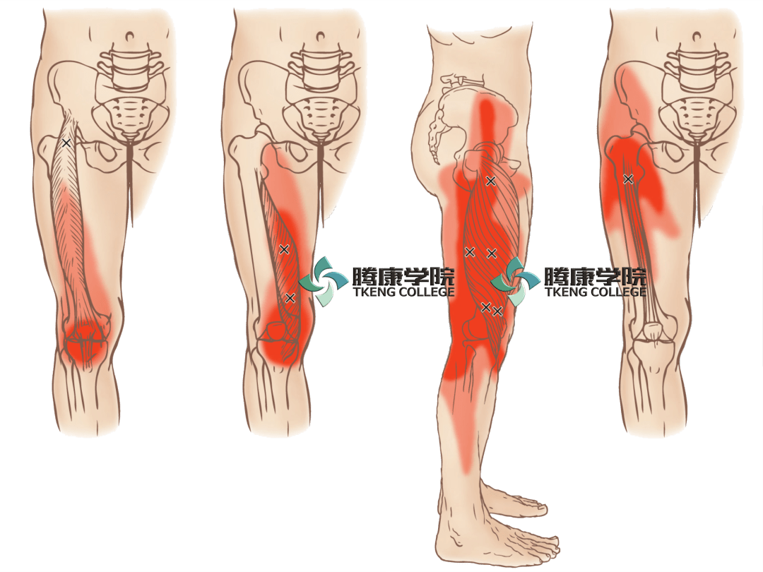 股外侧肌扳机点最常见的症状为膝部疼痛以及髋部和大腿外侧疼痛,位于