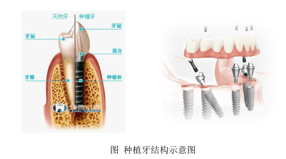 种植|口腔种植国产品牌仅占10%份额 大博医疗拟定增募资布局“种牙”