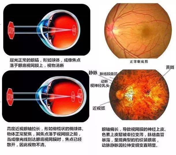 高度近视眼因为眼轴变长,视网膜变的比正常人薄,因此,出现视网膜裂孔