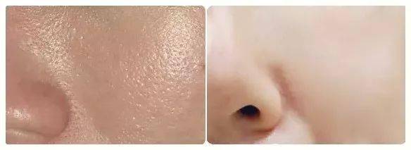 痘痘|夏天变黑长痘不可怕，赶紧用它，让你的皮肤恢复婴儿的光滑，痘痘，黑头，螨虫全都消失了