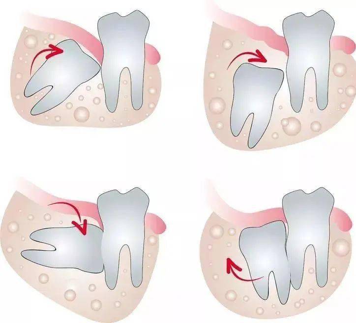 智齿的各种生长状态