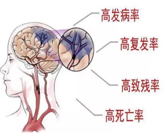 控制|【科普】如何预防脑卒中？