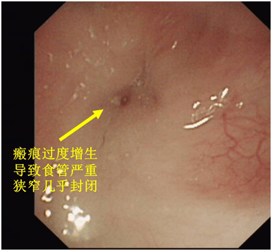 双镜|世界首例！我院完成双镜联合磁吻合技术微创治疗婴幼儿严重食管狭窄合并食管裂孔疝及返流性食管炎