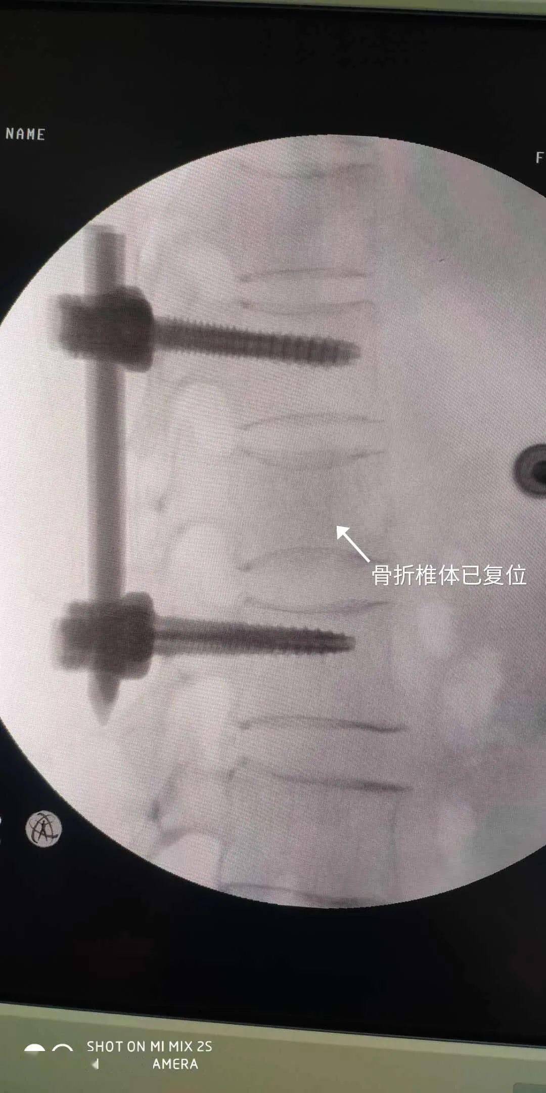 我院成功开展经皮脊柱椎弓根钉内固定手术