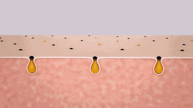 鼻子|米粒大的黑头，瞬间吸出，整个鼻子新生了！