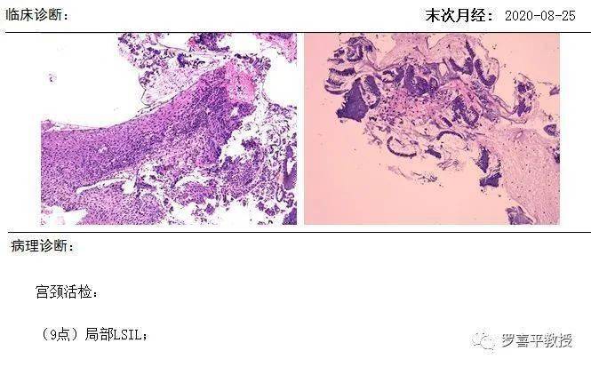 宫颈活检病理:低度鳞状上皮内病变(lsil)