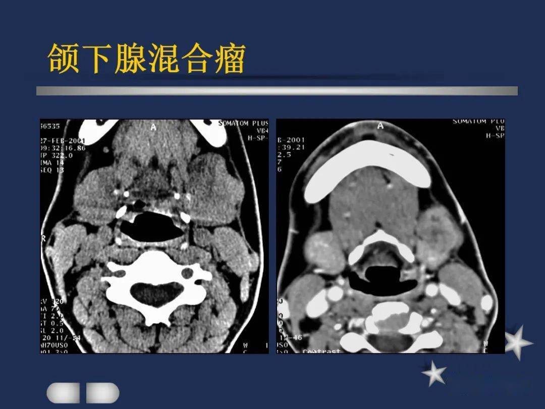 腮腺颈部疾病影像诊断