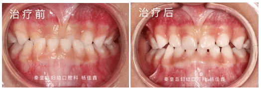 治疗|最佳时机别错过！孩子牙齿矫正