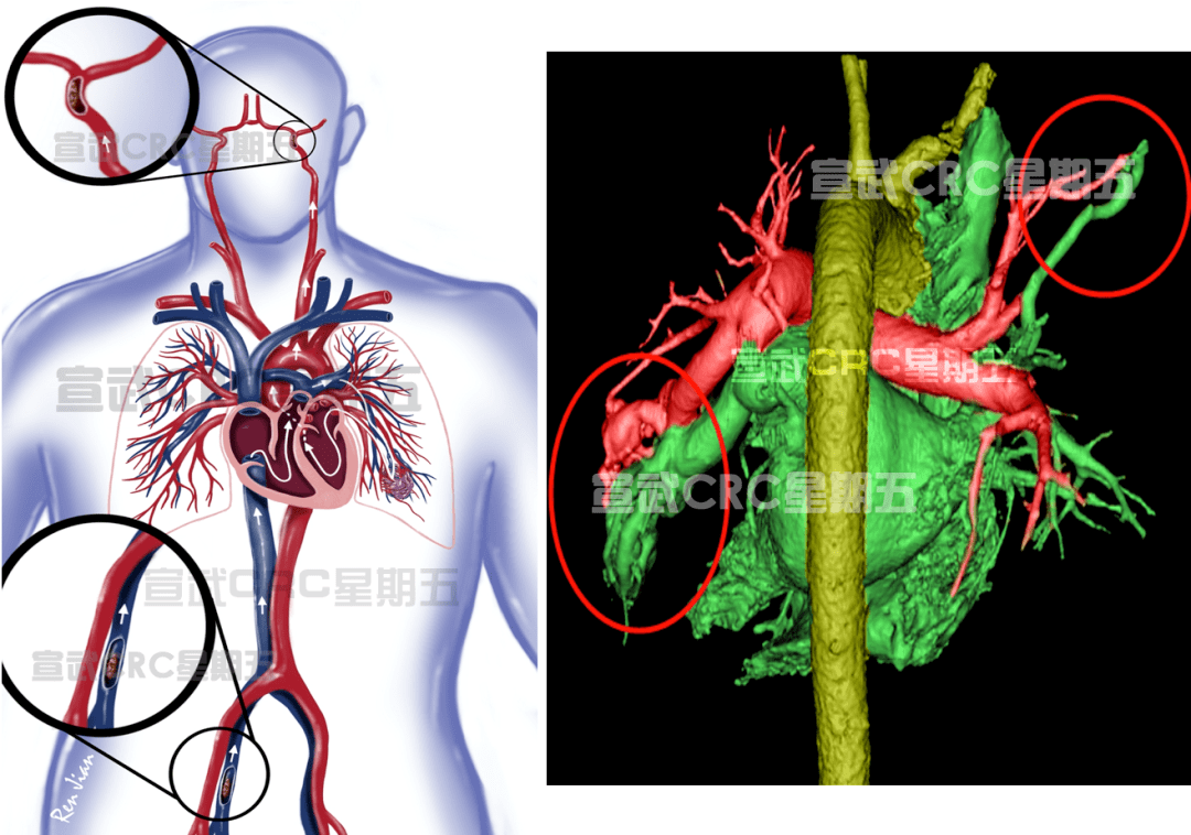 宣武crc星期五丨国际首例急诊取栓之肺动静脉畸形反常栓塞