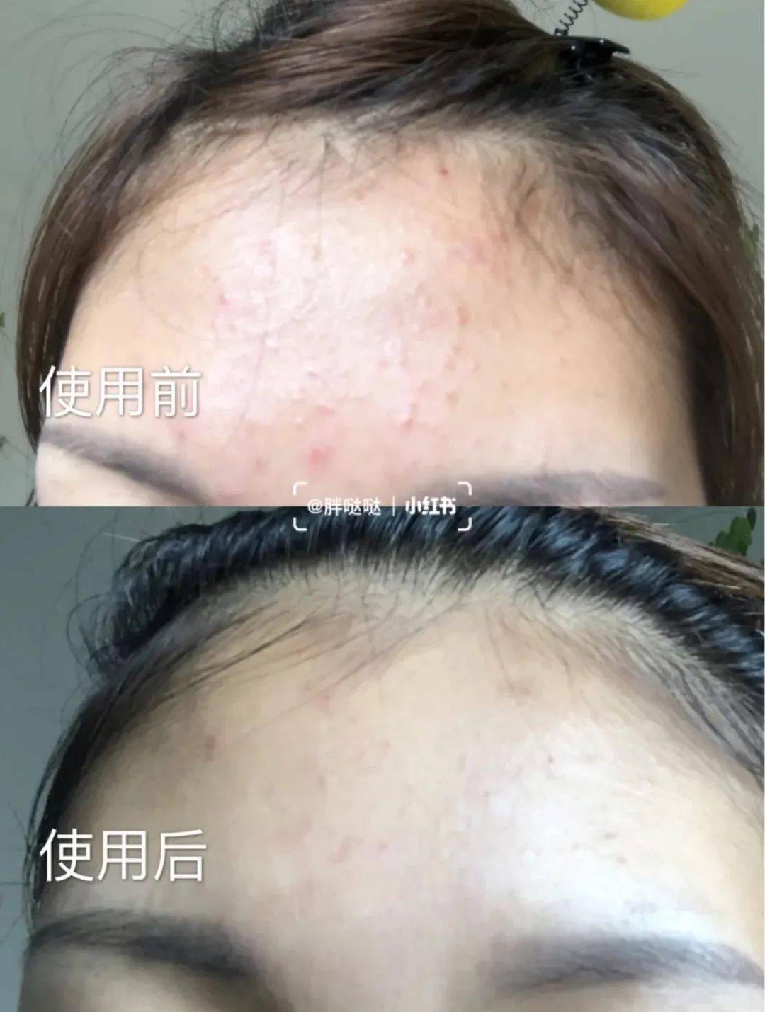 皮肤|刷酸=换脸？这个明星们超爱的百元刷酸好物搞定你的痘痘、闭口、黑头毛孔粗大还不怕烂脸！