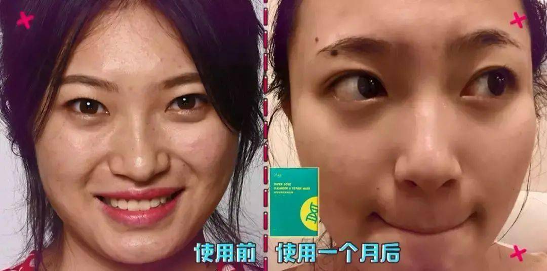 皮肤|刷酸=换脸？这个明星们超爱的百元刷酸好物搞定你的痘痘、闭口、黑头毛孔粗大还不怕烂脸！