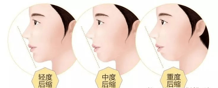 聊聊用嘴呼吸很伤牙!记录牙齿变"歪"全过程