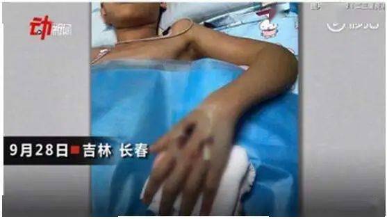 孩子|被咬进ICU！多家医院都没法治，妈妈大哭：我没管好……【警惕】13岁男孩网购“宠物”