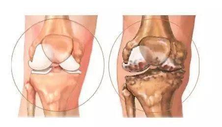 收藏常见的八大骨关节疾病