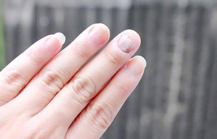 真菌|用“笔”刷一刷，灰指甲竟慢慢变光亮了